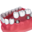 Dental Bridges